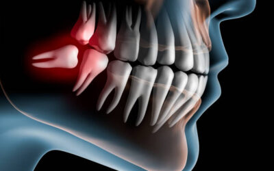 Denti del Giudizio Estrazione SI o NO